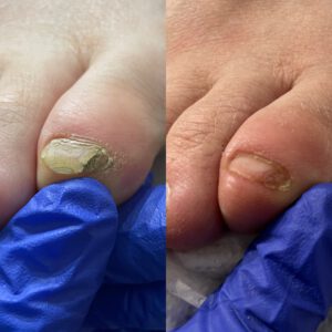 podomedic paznokcie zmienione chorobowo
